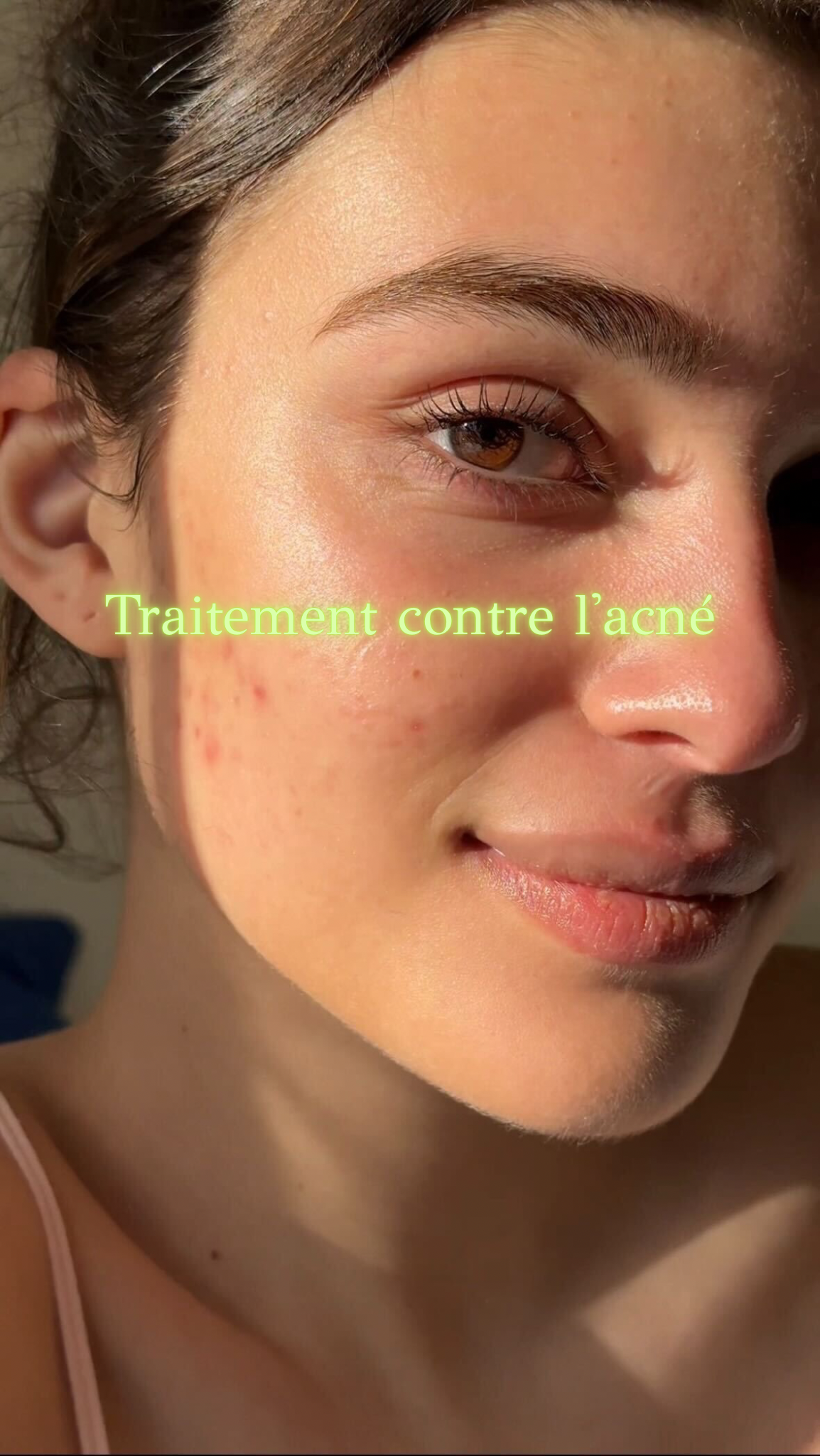 Traitement contre l’acné